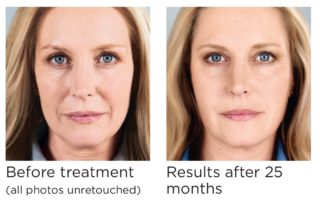 Injections for Nasolabial Wrinkles