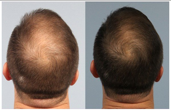 Testosterone and Hair Loss in Males Whats the Link