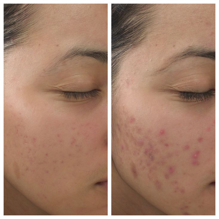 Microlaser Peel treatment