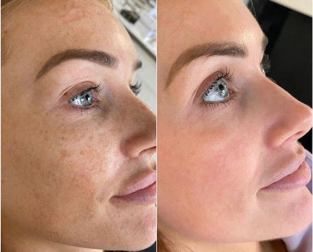 Chemical Peel treatment