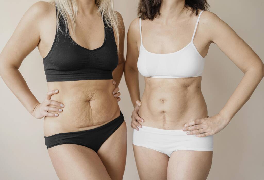 Tummy Tuck before after 
