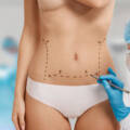 Tummy Tuck Pittsburgh Success Stories: Real Results & What to Expect