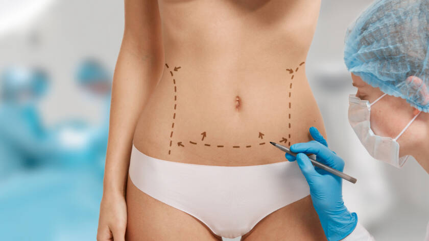 Tummy Tuck surgery treatment