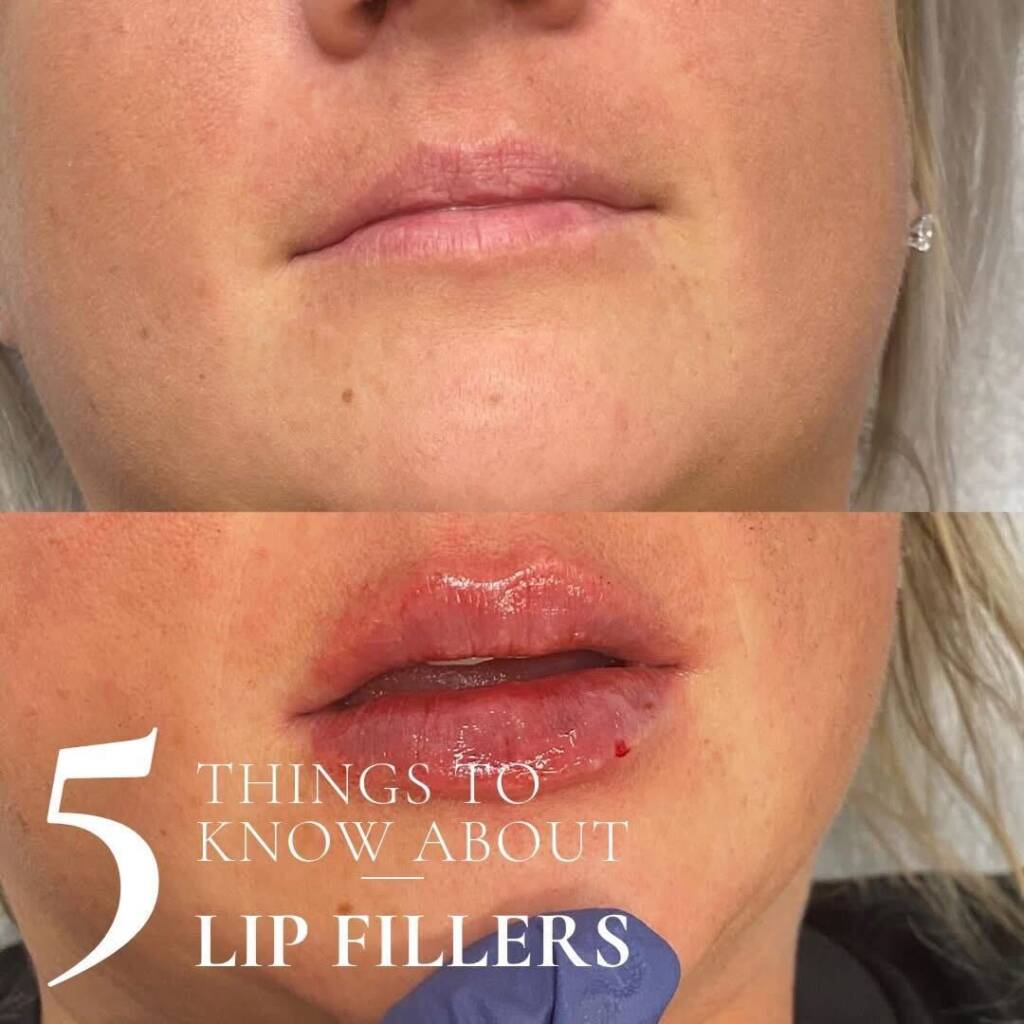 lip fillers