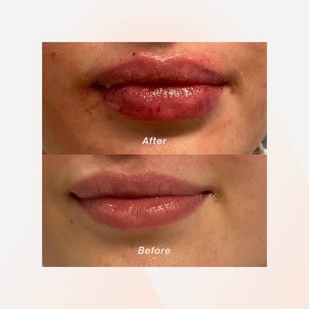 lip fillers pittsburgh