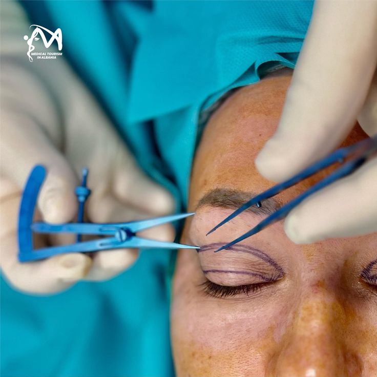 blepharoplasty treatment