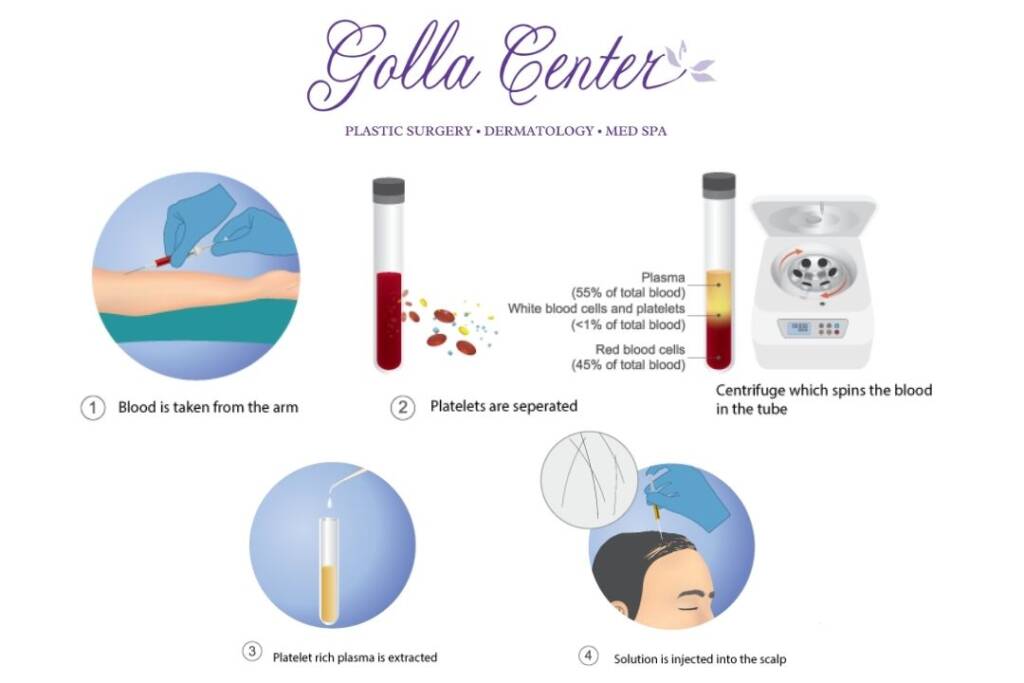 PRP Treatment in Pittsburgh | Hair Restoration | Golla Center